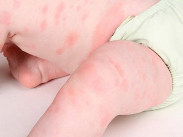 Phòng ngừa và xử trí dị ứng thực phẩm ở trẻ em