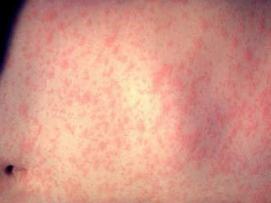 Dễ nhầm sốt phát ban với bệnh sởi, sốt xuất huyết