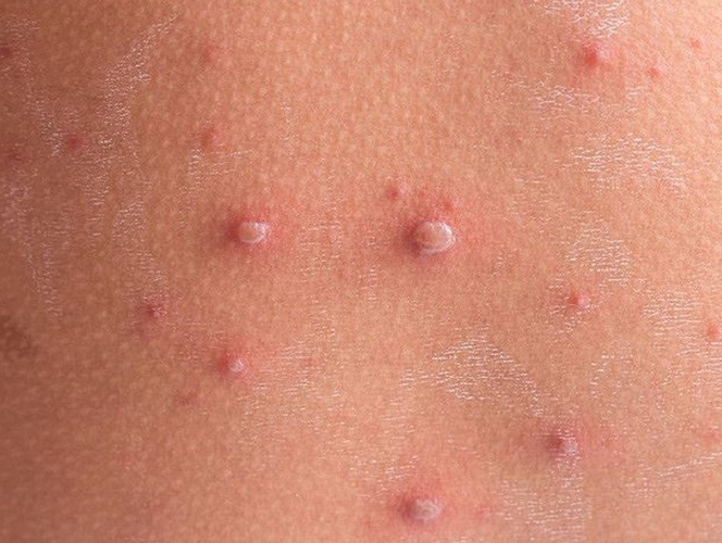 Chẩn đoán, sàng lọc HIV cho trẻ em có nguy cơ cao