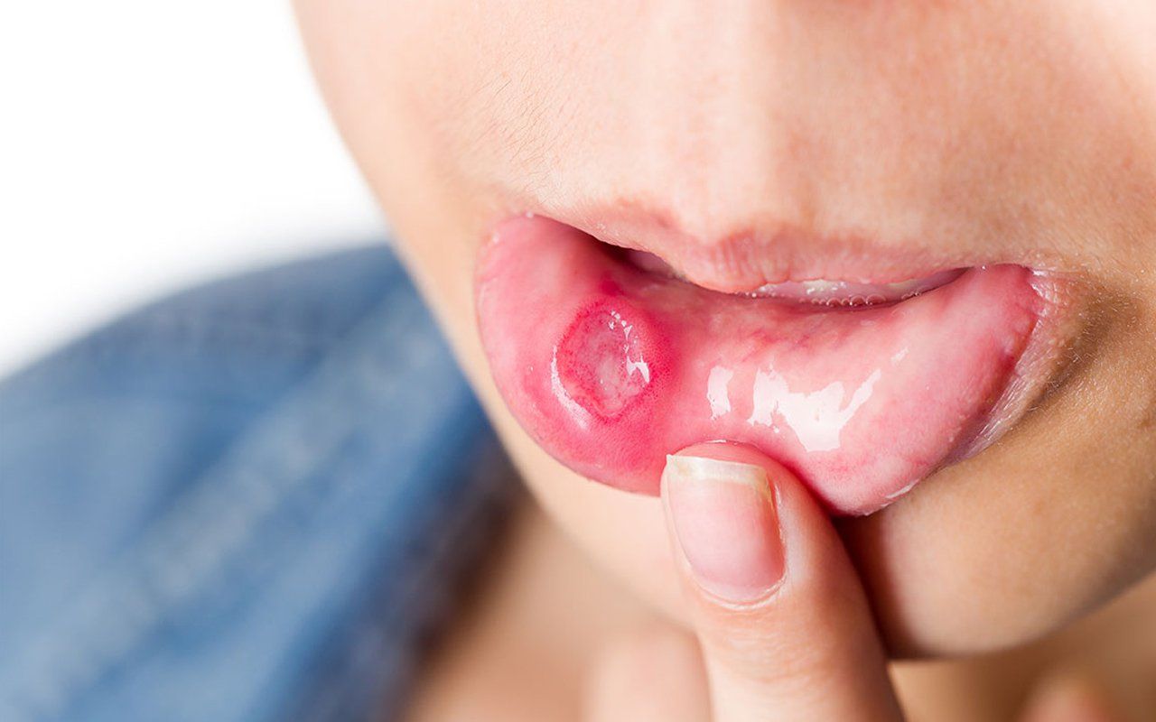 Biểu hiện tay chân miệng theo từng giai đoạn ủ bệnh - khởi phát - toàn phát
