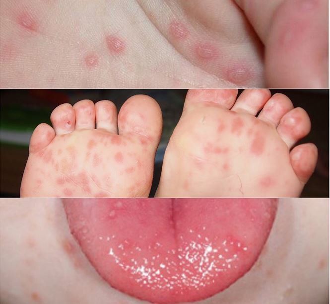 Không có thuốc đặc hiệu điều trị tay chân miệng, chỉ có thể điều trị triệu chứng