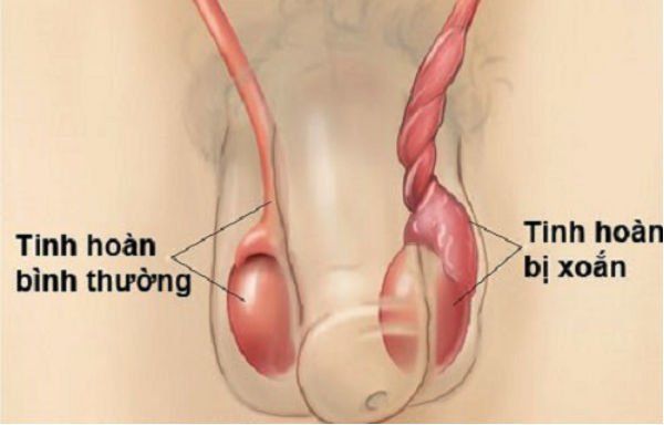 Các tác nhân gây sưng bìu ở trẻ em