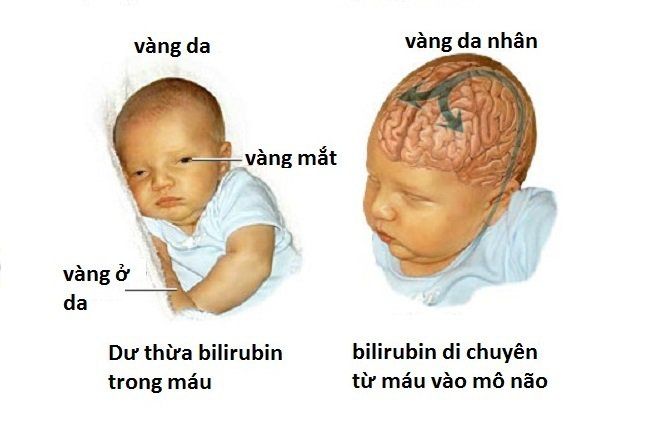 Thế nào là vàng da nhân não?