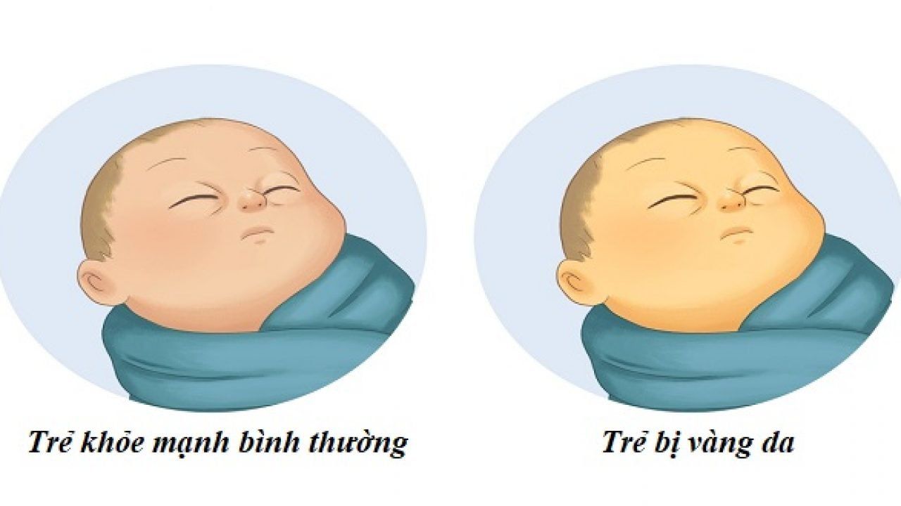 Làm thế nào khi trẻ sơ sinh bị vàng da kéo dài?