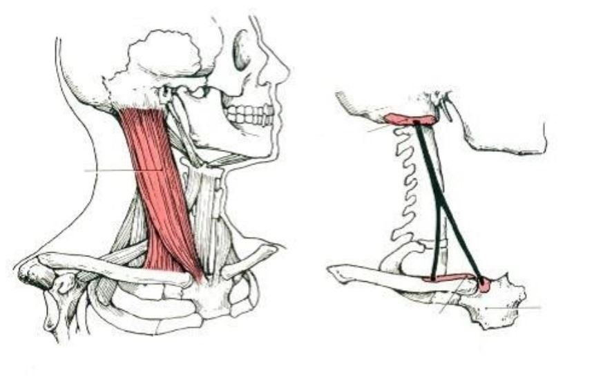 Vẹo cổ ở trẻ nhỏ