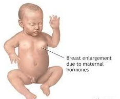 Chứng vú to ở trẻ sơ sinh