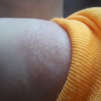 Da bé 3 tháng bị khô, vảy như này bôi gì hiệu quả?