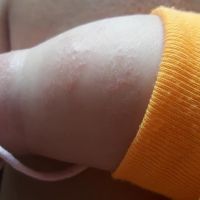 Da bé 3 tháng bị khô, vảy như này bôi gì hiệu quả? Da bé 3 tháng bị khô, vảy như này bôi gì hiệu quả?