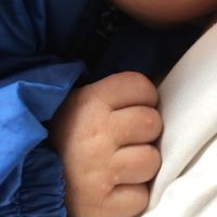 Bé gần 4 tháng bị nổi mụn nước ở tay và chân