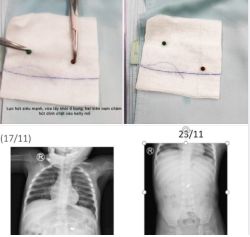 Hai viên bi hút nhau đi xuyên thành ruột  bám chặt vào mạc treo ruột non hơn 6 tháng trong bụng bé trai vì lực nam châm siêu hút..