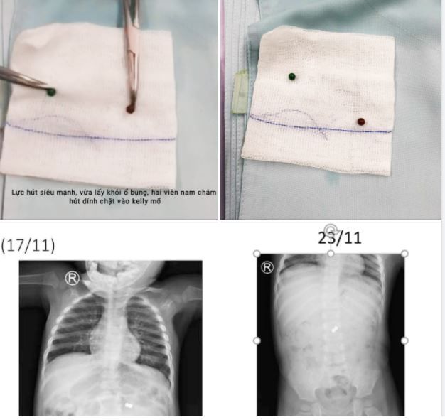 Hai viên bi hút nhau đi xuyên thành ruột  bám chặt vào mạc treo ruột non hơn 6 tháng trong bụng bé trai vì lực nam châm siêu hút..