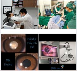 Cườm mắt (đục thủy tinh thể trẻ em) thì có mổ được an toàn và hết hẳn không?