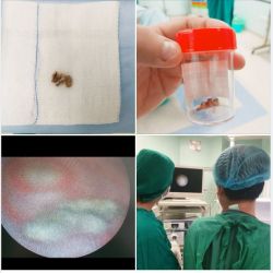 MẢNH BÔNG GÒN GÂY VIÊM NHIỄM VÙNG KÍN, TIẾT DỊCH VÀNG HÔI NGỨA SUỐT 1 THÁNG CHO BÉ GÁI 6 TUỔI