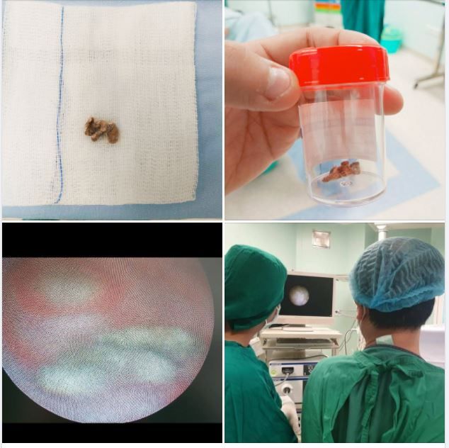 MẢNH BÔNG GÒN GÂY VIÊM NHIỄM VÙNG KÍN, TIẾT DỊCH VÀNG HÔI NGỨA SUỐT 1 THÁNG CHO BÉ GÁI 6 TUỔI