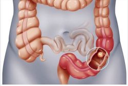 LẰN RANH MỎNG MANH GIỮA BỆNH POLYP ĐẠI TRÀNG VÀ UNG THƯ