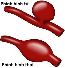 Những điều cần biết về phình động mạch não - Bệnh viện Việt Đức