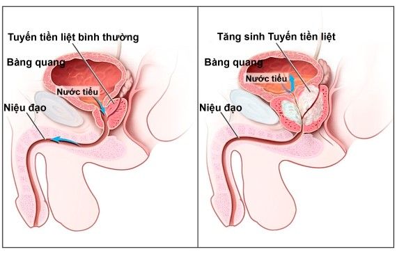 Bệnh tăng sản lành tính tuyến tiền liệt - Bênh viện 108