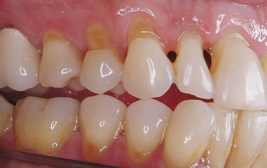 Một số điều cần biết về mòn, tiêu cổ răng - Bệnh viện 108