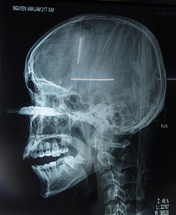 Hoảng hồn nam thanh niên bị lưỡi cưa cắm vào giữa mặt, mang thẳng tới viện - Bệnh Viện Việt Đức