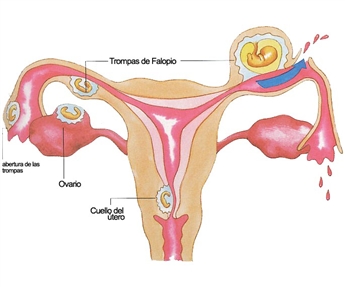 Thai ngoài tử cung: điều cơ bản cần biết - Bệnh viện Từ Dũ