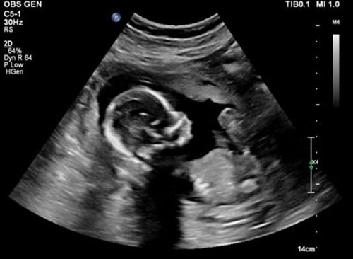 Mẹ bầu nên làm gì khi nước ối ít - Bệnh viện Từ Dũ
