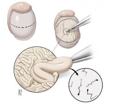 Kỹ thuật thu nhận tinh trùng bằng phẫu thuật xẻ tinh hoàn  (TESE – Testicular Sperm Extraction) - Bệnh viện Từ Dũ