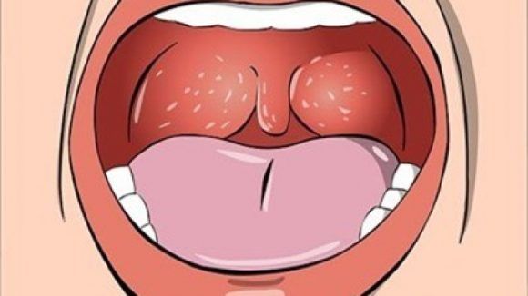Chăm sóc trẻ phẫu thuật nạo VA, cắt amidan - Bệnh viện nhi Trung Ương