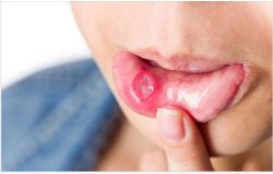 CHỮA NHIỆT MIỆNG NHANH NHẤT – HIỆU QUẢ NHẤT