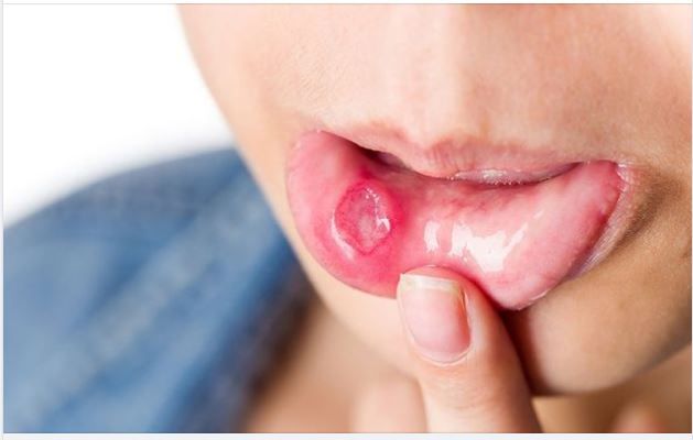 CHỮA NHIỆT MIỆNG NHANH NHẤT – HIỆU QUẢ NHẤT