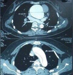 Bệnh nhân nhiễm HIV lóc động mạch chủ type A đầu tiên tại Việt Nam được phẫu thuật thành công - Bệnh viện Việt Đức