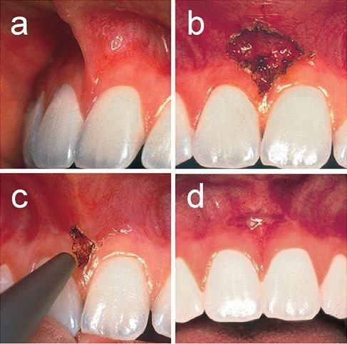 Laser - Xu hướng mới trong điều trị nha khoa - Bệnh viện 108