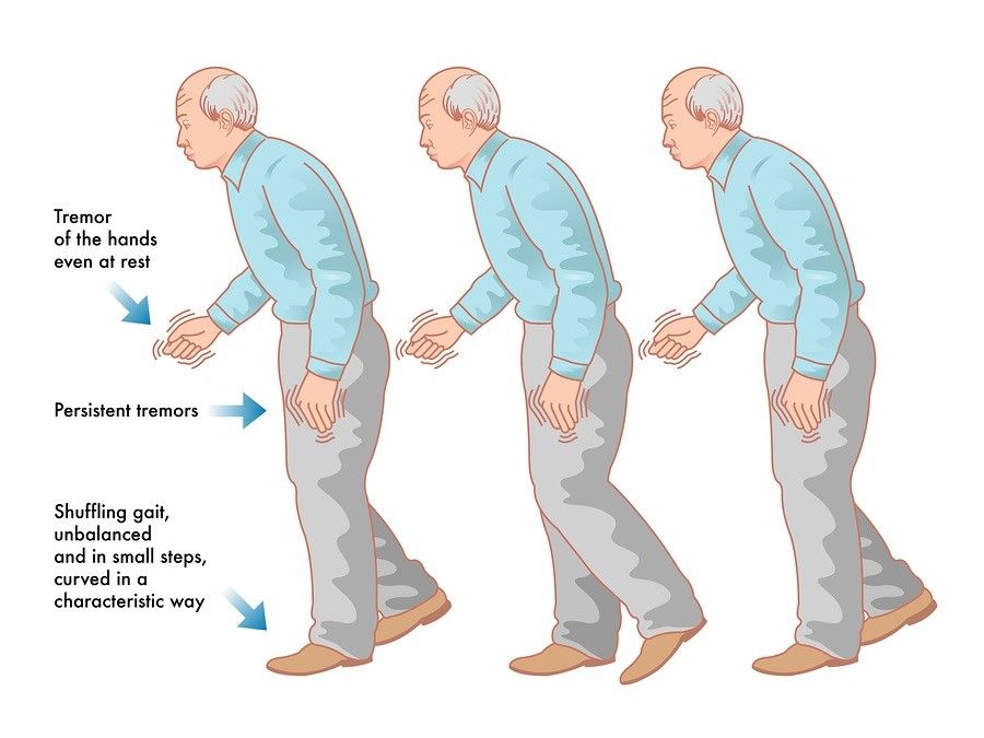 Một số điều cần biết về bệnh Parkinson - Bệnh viện 108