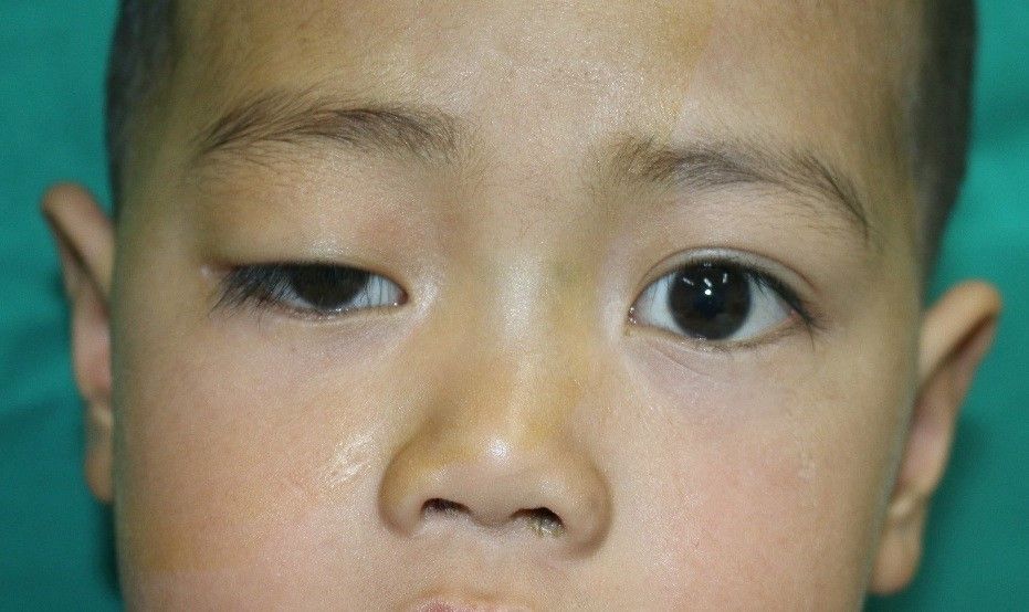Điều trị sụp mi bẩm sinh và mắc phải bằng kĩ thuật chuyển vạt cơ trán - Bệnh viện 108