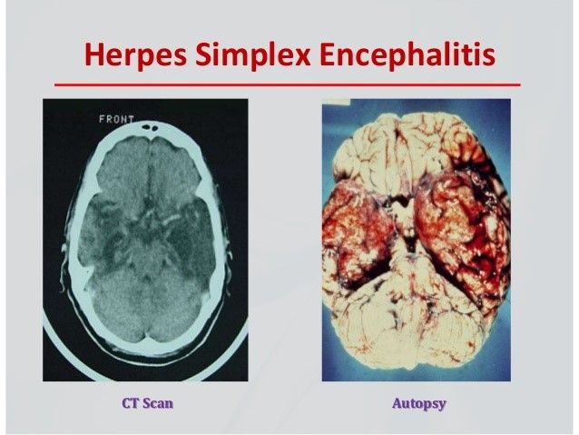 Bệnh viêm não do virus Herpes simplex: Một bệnh nguy hiểm cần được quan tâm - Bệnh viện 108
