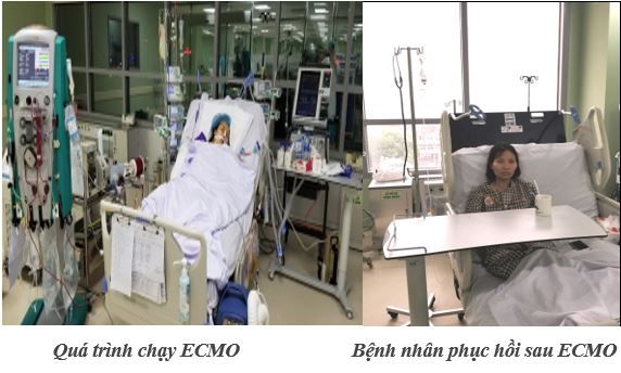 Cứu sống bệnh nhân viêm cơ tim tối cấp bằng kỹ thuật oxy hóa qua màng ngoài cơ thể (ECMO) - Bệnh viện 108