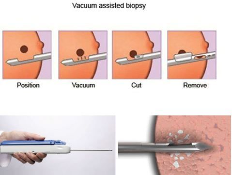 Kỹ thuật sinh thiết vú có hỗ trợ thiết bị hút chân không VABB - Bệnh viện 108