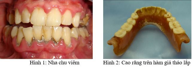 Chứng hôi miệng: Một số điền cần biết - Bệnh viện 108