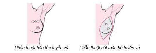 Phẫu thuật ung thư vú: cắt bỏ hay bảo tồn tuyến vú - Bệnh viện 108