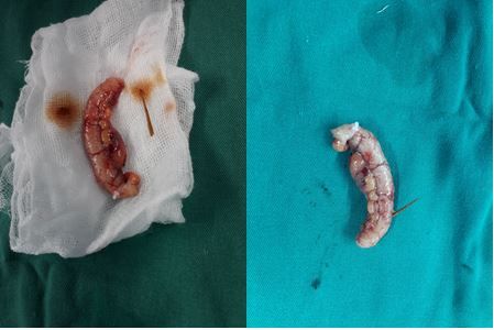 Thủng ruột thừa do vô tình nuốt phải tăm xỉa răng - Bệnh viện 108