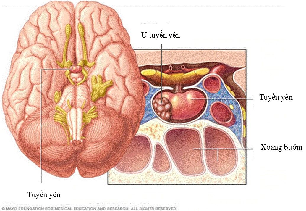 Xạ trị điều trị u tuyến yên - Bệnh viện 108