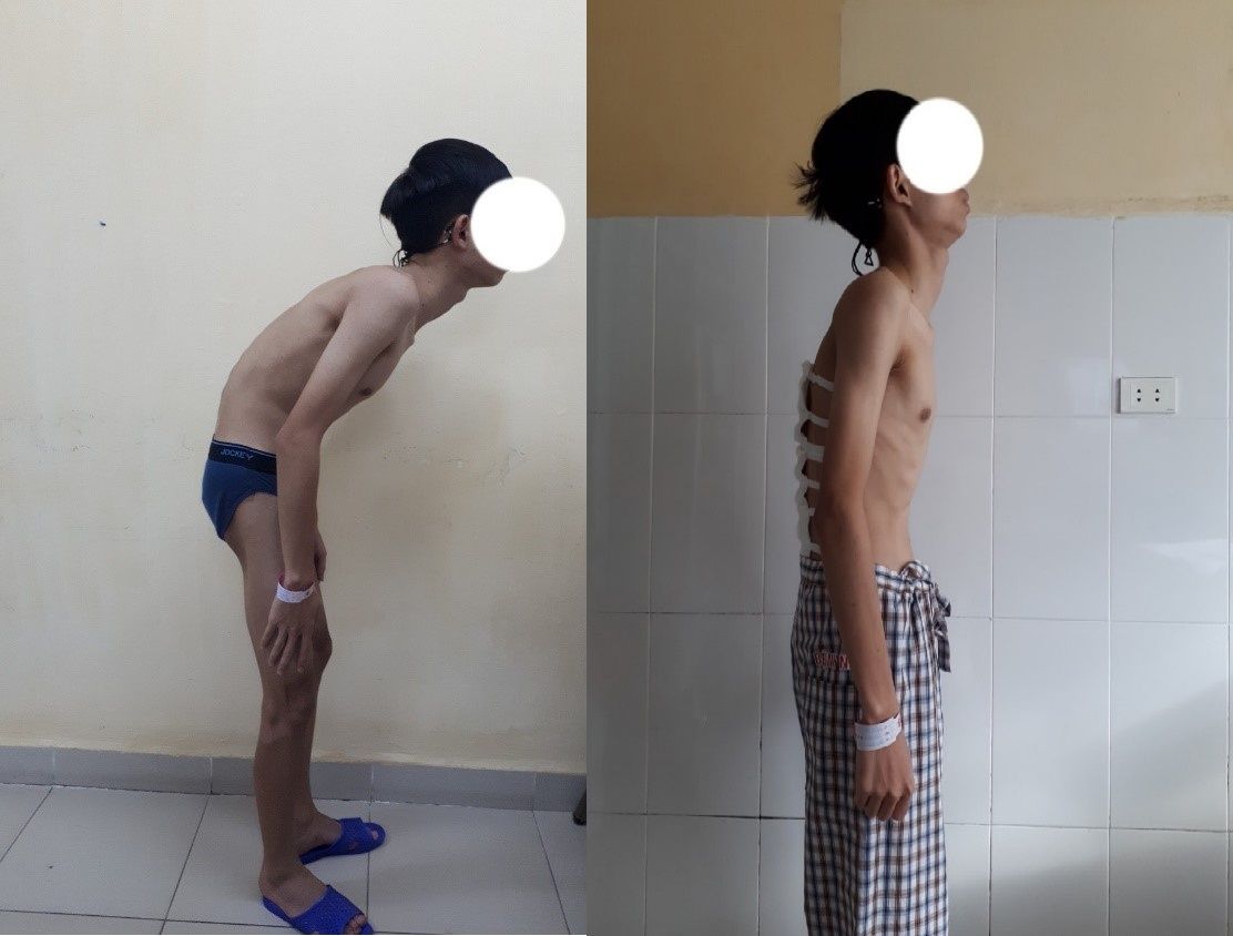 Phẫu thuật cho thanh niên 22 tuổi bị gù nặng - Bệnh viện 108