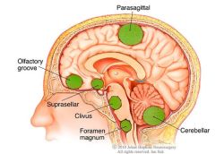 Những dấu hiệu và triệu chứng cảnh báo bệnh u não - Bệnh viện 108