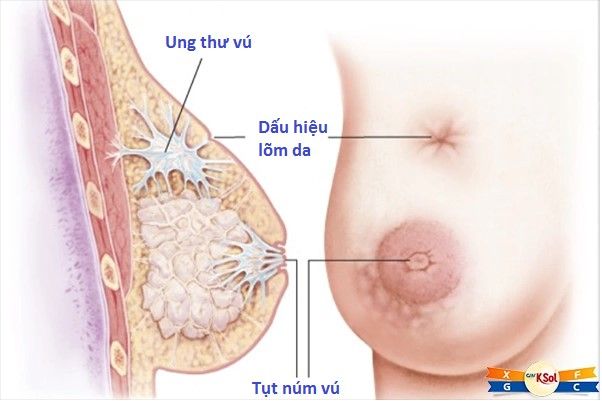 Tập thể dục và lợi ích với bệnh ung thư vú - Bệnh viện 108