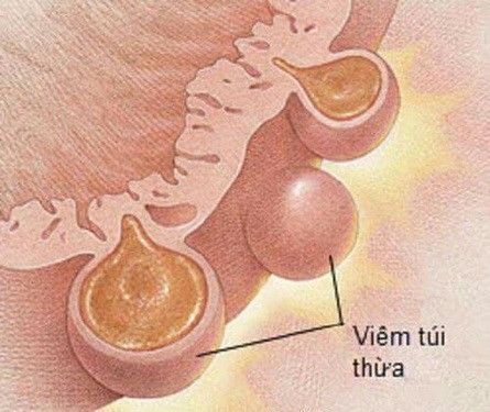 Một số điểm cần biết về viêm túi thừa manh tràng - Bệnh viện 108