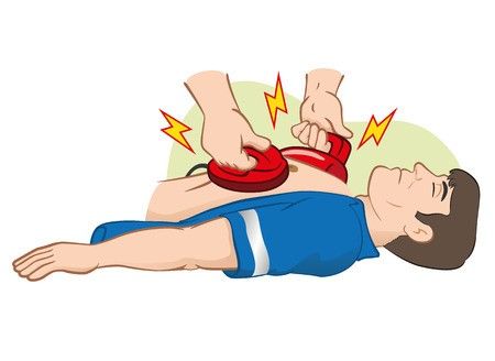 Cấp cứu thành công một trường hợp ngừng tuần hoàn ngoại viện do rối loạn nhịp - Bệnh viện 108