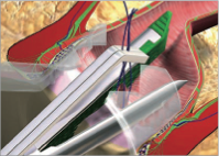 Điều trị rò hậu môn phức tạp bằng phương pháp nội soi đường rò: VAAFT – Video Assisted anal fistula treatment - Bệnh Viện Việt Đức