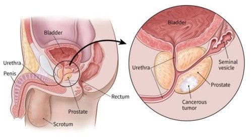 Phát hiện sớm, phòng và điều trị ung thư tiền liệt tuyến - Bệnh viện 108