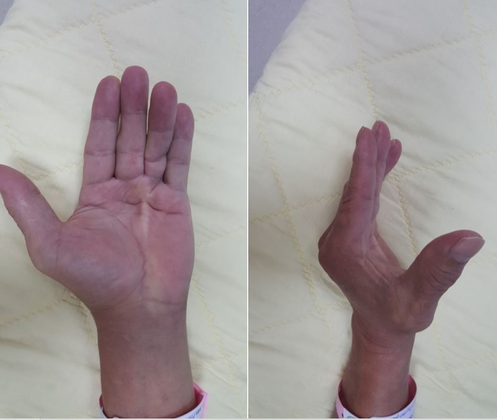Co rút cân gan tay (co rút dupuytren) - Bệnh viện 108