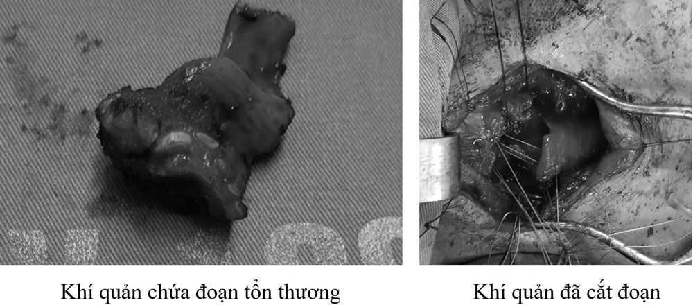 Phẫu thuật cắt đoạn - tạo hình khí quản trên bệnh nhân ung thư tuyến giáp tái phát - Bệnh viện 108