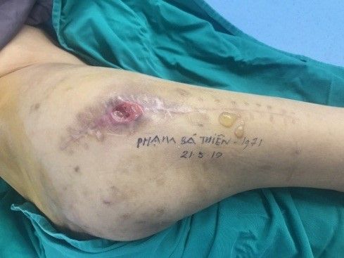 Trám vạt cơ rộng ngoài vào ổ cối - Bệnh viện 108